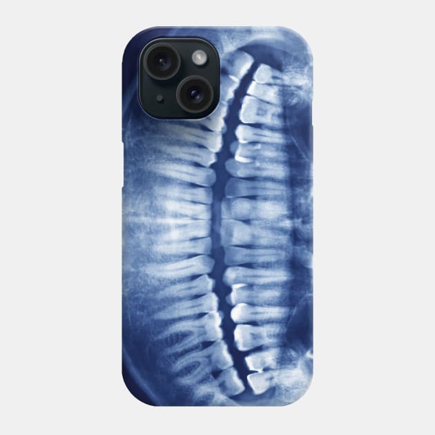 You See Right Through Me aka X-ray Smile Phone Case by Dump.C