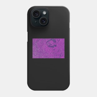 Glitter Moonwalker No. 10 Phone Case