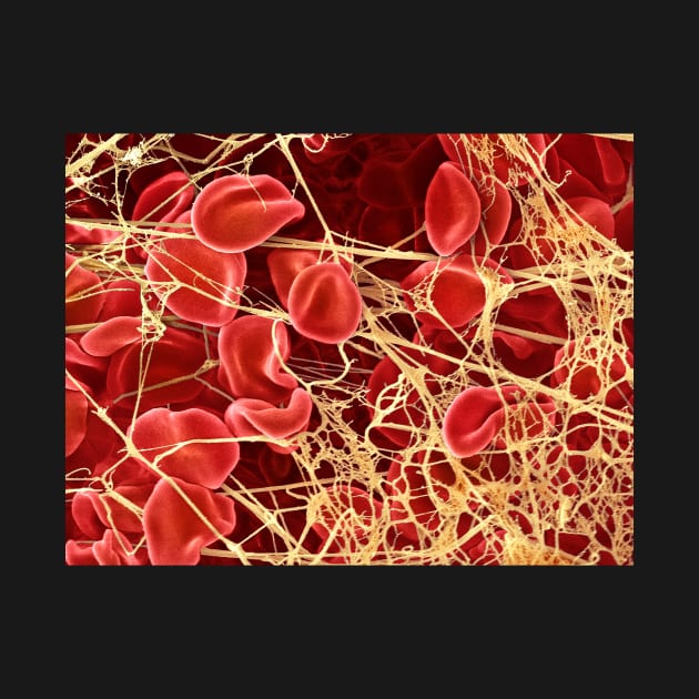 Blood clot, SEM (P260/0107) by SciencePhoto