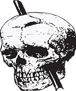 Black and White Skull of Phineas Gage With Tamping Iron Magnet