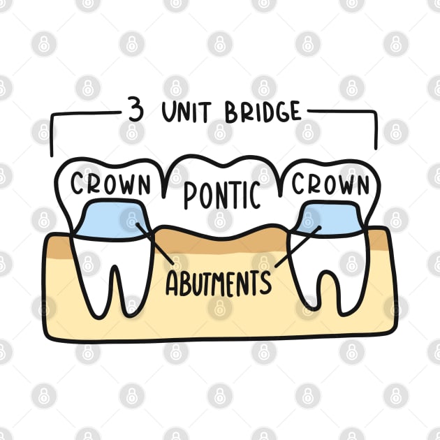 Hand Drawn Labeled Dental Bridge by Sofia Sava