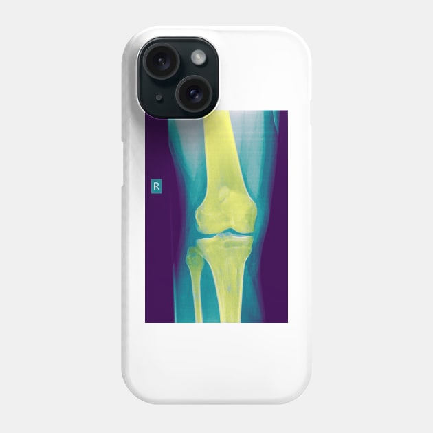 Knee x-ray (C022/3104) Phone Case by SciencePhoto