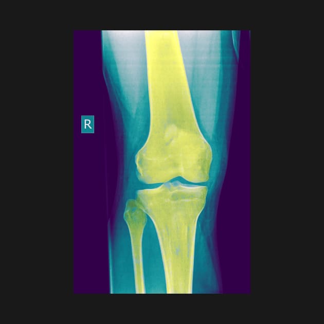 Knee x-ray (C022/3104) by SciencePhoto