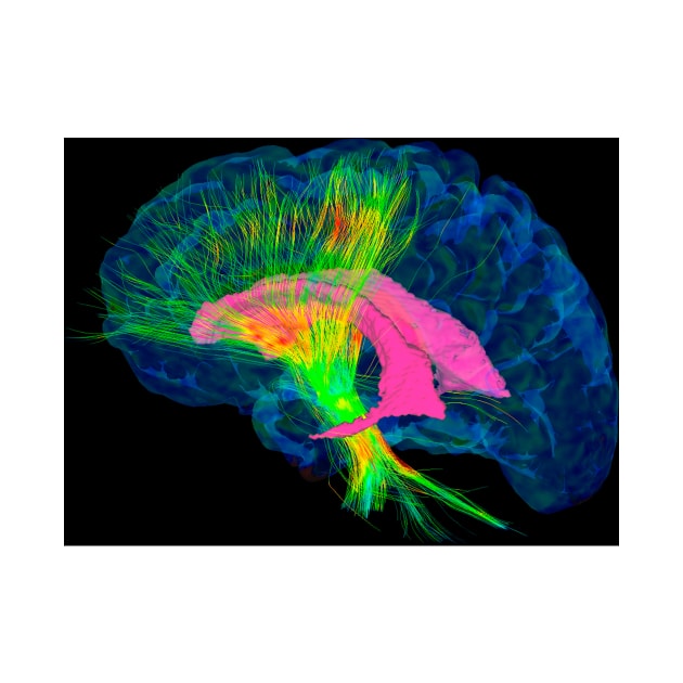 Brain fibres, DTI MRI scan (C017/7036) by SciencePhoto