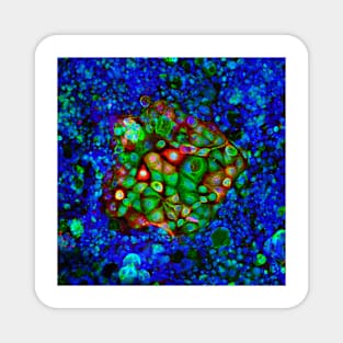 Colorectal cancer cells, light micrograph (C021/6371) Magnet
