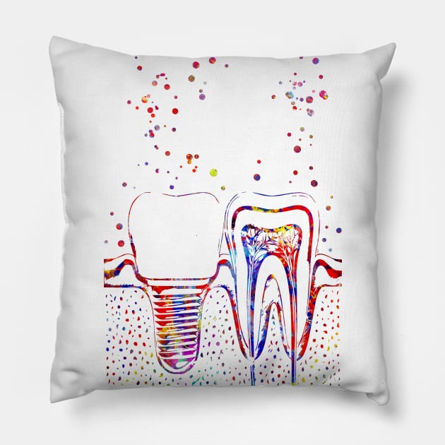 Human teeth and dental implant, Pillow by RosaliArt