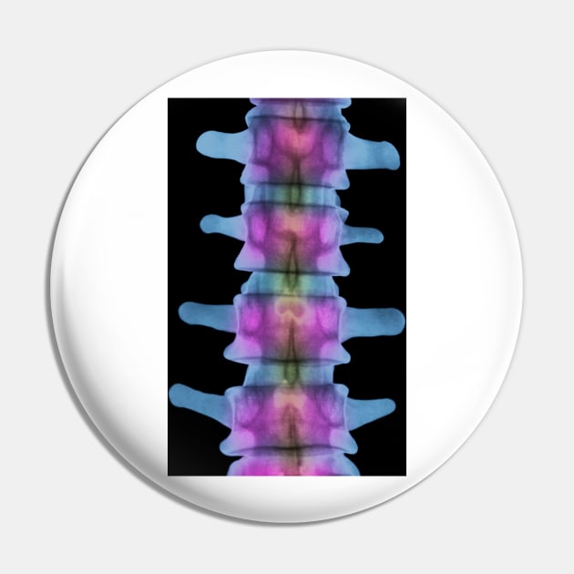 Lumbar spine, X-ray (P116/0393) Pin by SciencePhoto