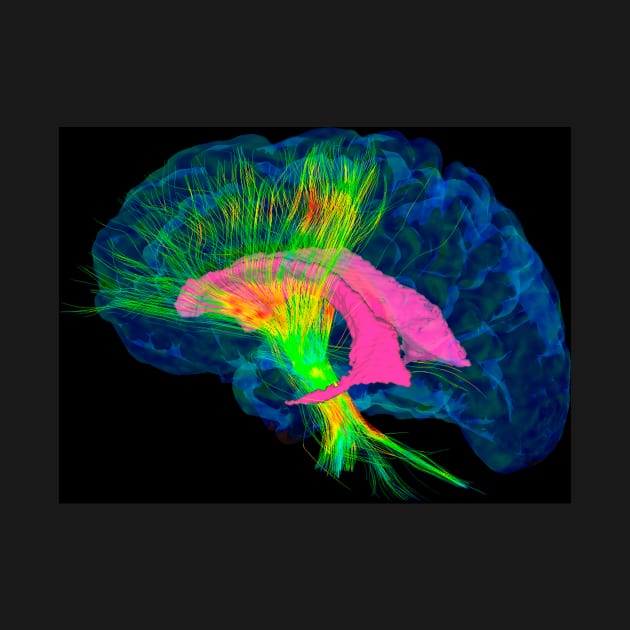 Brain fibres, DTI MRI scan (C017/7036) by SciencePhoto