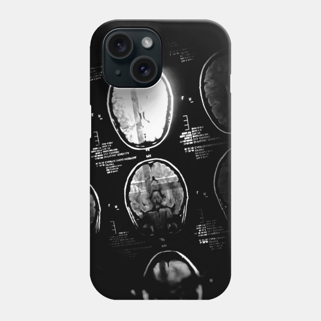 Brain Ray Phone Case by hitext