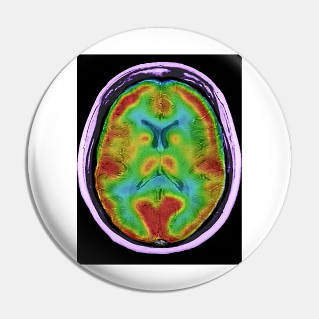 Normal brain blood flow, MRI and SPECT (C026/8000) Pin by SciencePhoto