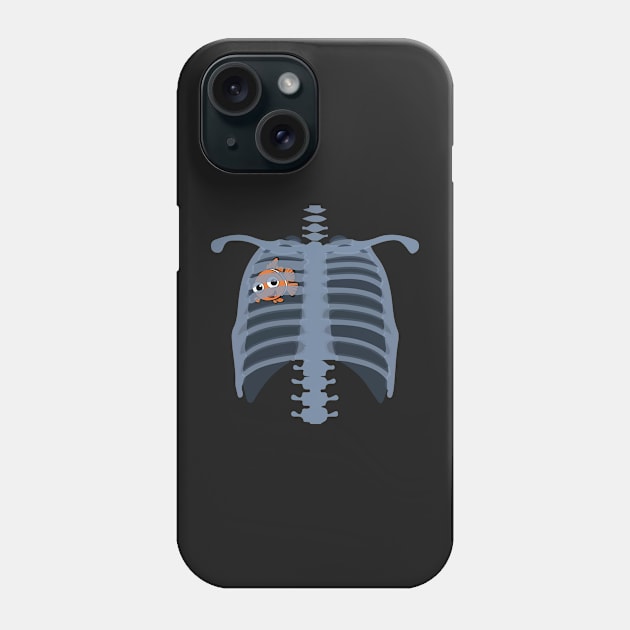 Nemo Thorax (Pneumothorax) Phone Case by bwoody730