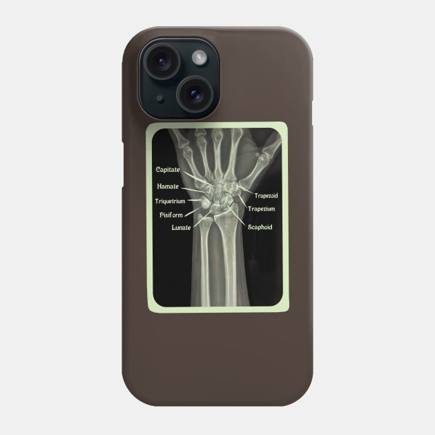 XRAY of Carpal Bones Mixed Media Phone Case by ckrickett