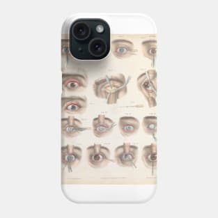 What is Within Us Vintage Tee Collection// Eye Surgery Phone Case