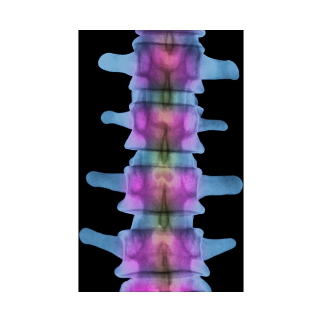 Lumbar spine, X-ray (P116/0393) by SciencePhoto