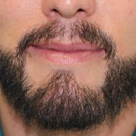 DHI Brisbane Clinic after_4.jpg
