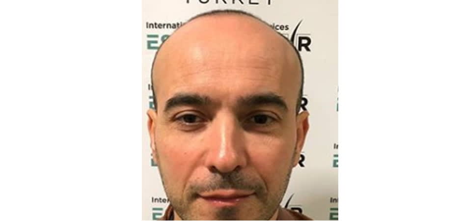 Esthetic Hair Turkey before_2.jpg