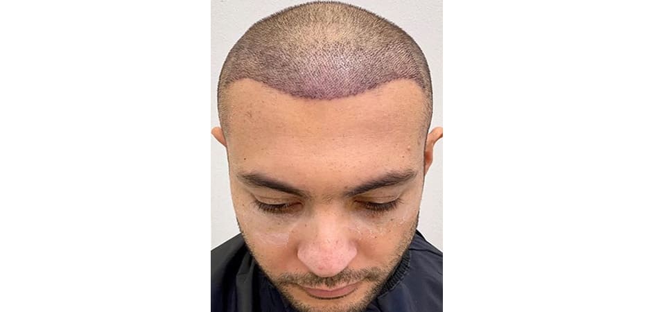 Baday Hair Center Kuwait after_1.jpg