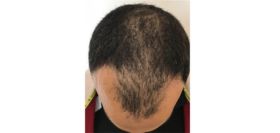 Baday Hair Center Kuwait before_2.jpg
