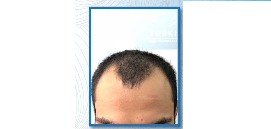Hair Transplant Center In Dubai after_1.jpg