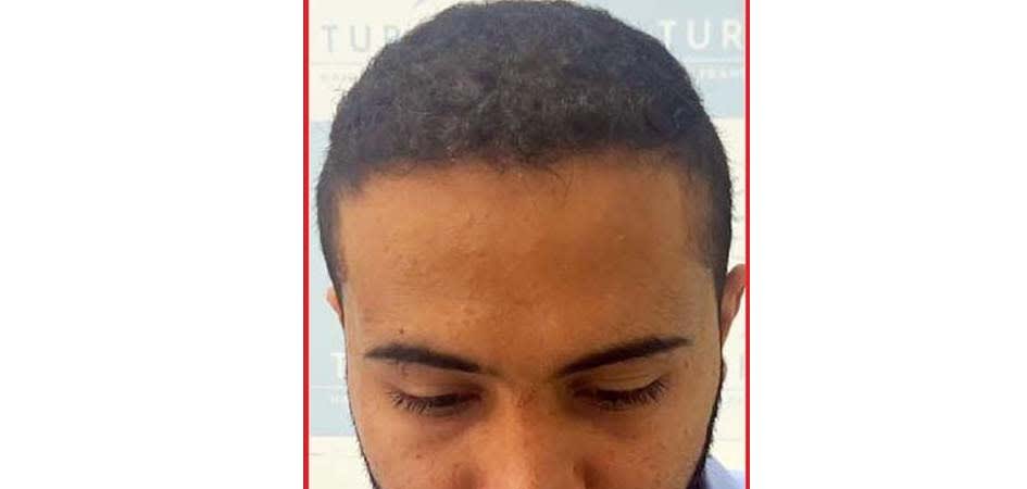 Hair Transplant Center In Dubai Review Hair Transplant Center In Dubai Review