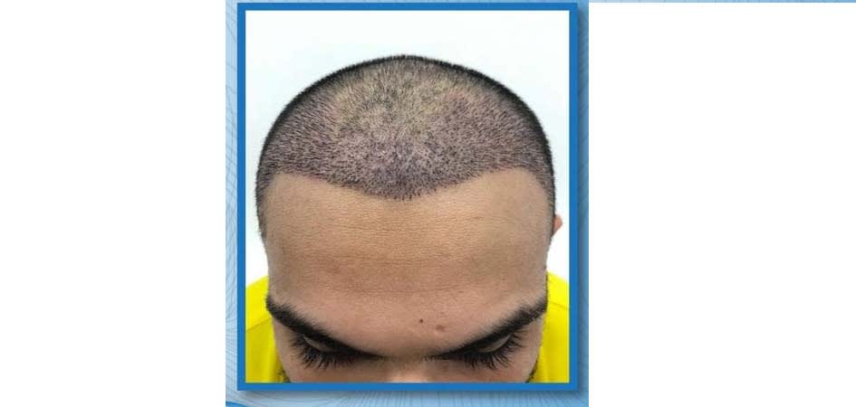 Hair Transplant Center In Dubai Review Hair Transplant Center In Dubai Review