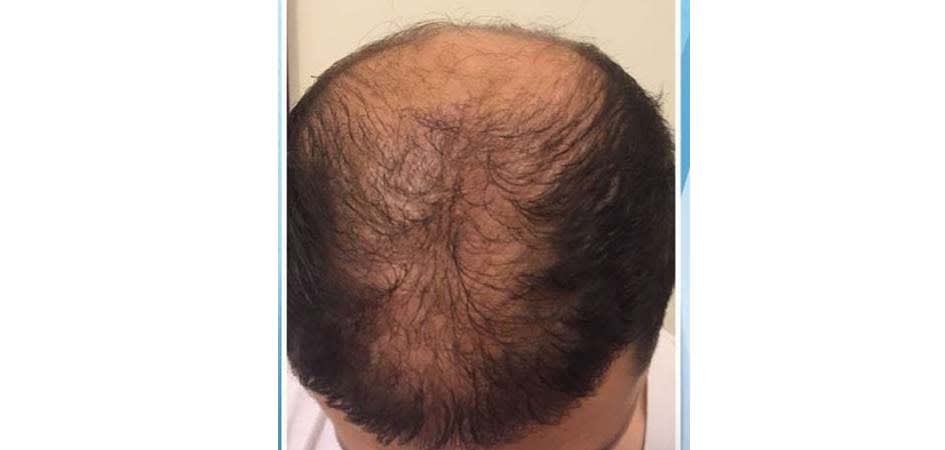 Hair Transplant Center In Dubai Review Hair Transplant Center In Dubai Review