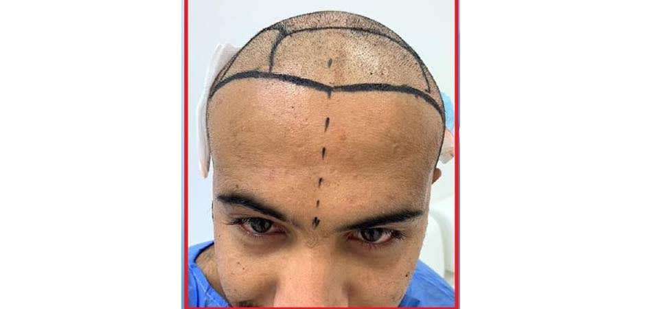 Hair Transplant Center In Dubai before_3.jpg
