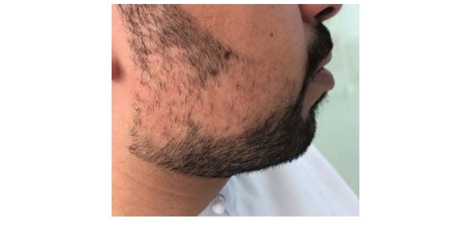 Hair Transplant Center In Dubai before_4.jpg