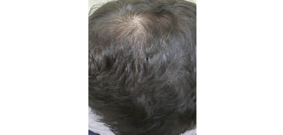 Hair Transplant Panama after_1.jpg