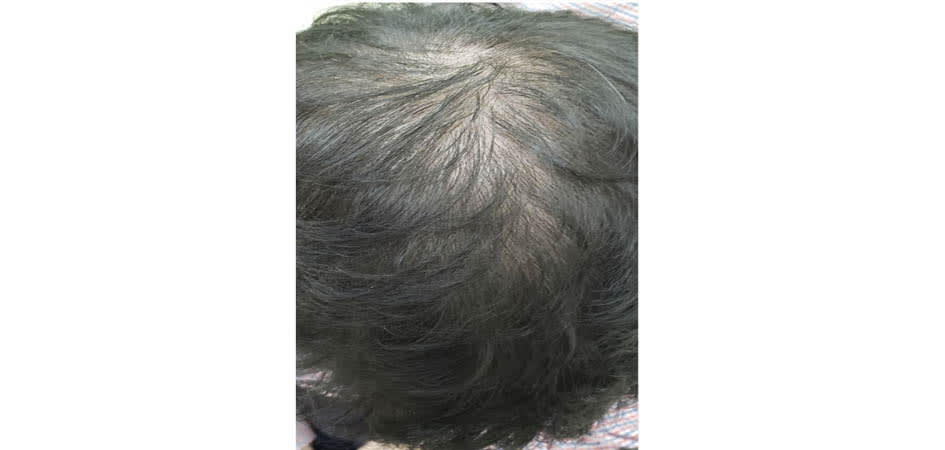 Hair Transplant Panama before_1.jpg