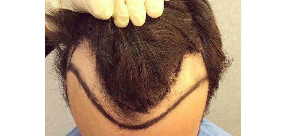 Smile Hair Clinic smilehair_before2.jpg