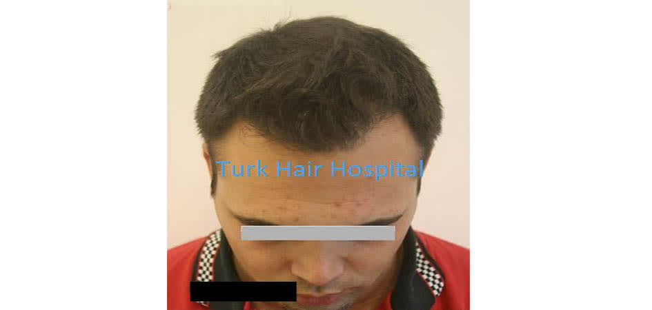 TMH Turkey Medical Health after_2.jpg