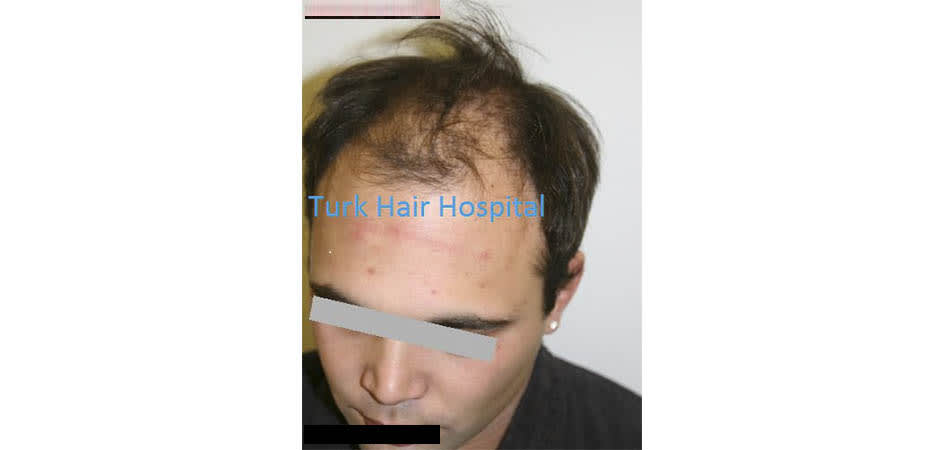 TMH Turkey Medical Health before_2.jpg
