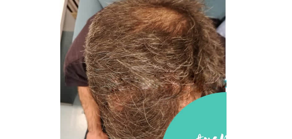 TMH Turkey Medical Health before_3.jpg