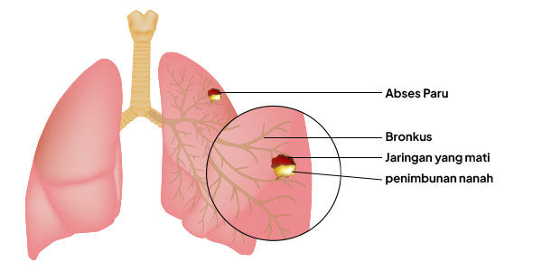 Gambar Kondisi Abses Paru