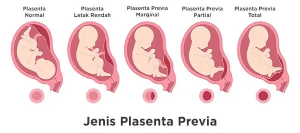 Jenis Jenis Plasenta Previa