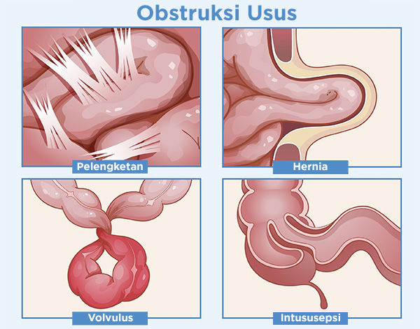 Jenis Obstruksi Usus Mekanis