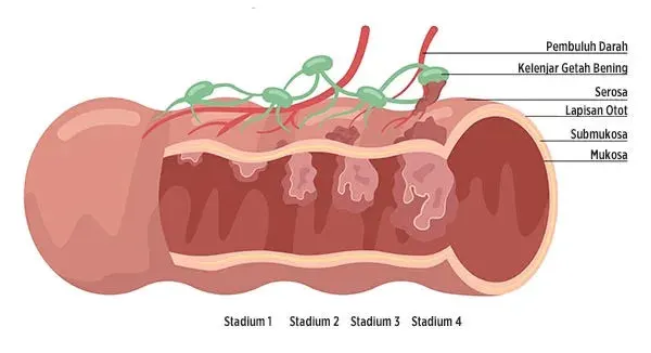 Urutan Stadium Kanker Usus Besar
