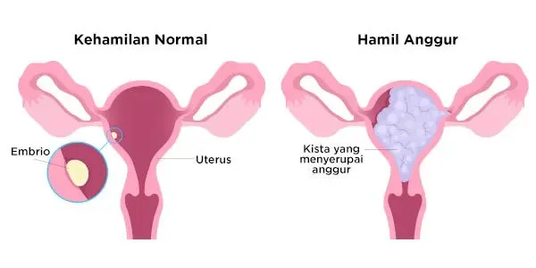 Visualisasi Hamil Anggur