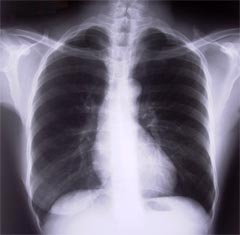 Normal Xray of chest. Heart in the centre.