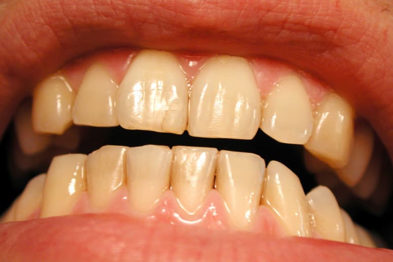 Symptoms of Iron Deficiency from 8 Common Nutrient Deficiencies and