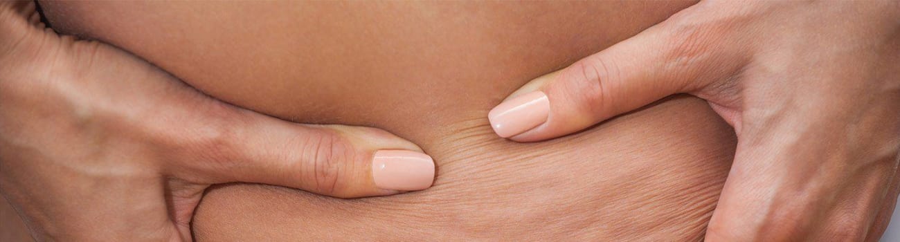 Cellulite