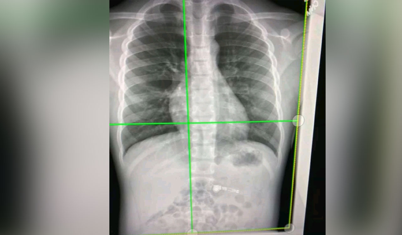 Chest X-Rays