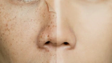 Skin Pigmentation In Winter