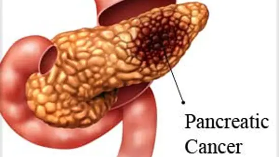 Pancreatic Cancer