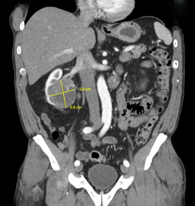 CT image — follow-up scan