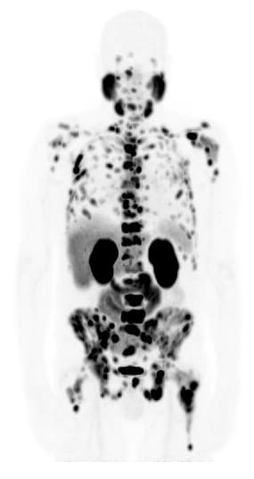 Ga-68 PSMA PET scan showing widespread cancer in the bones