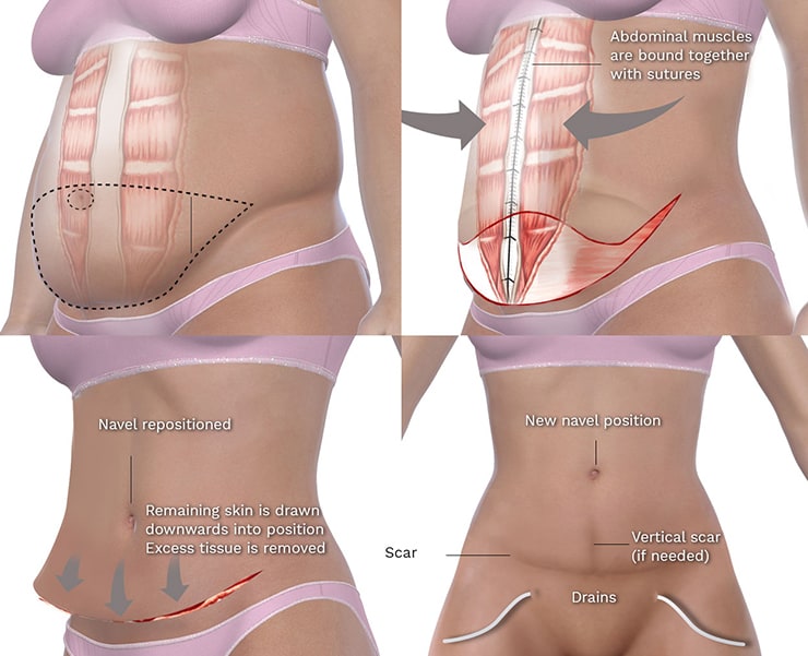 Drain Free Tummy Tuck Toronto Abdominoplasty All Female Staff