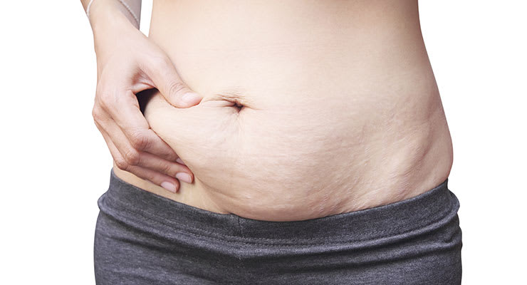 Why Women Get Tummy Tucks After Having A Baby