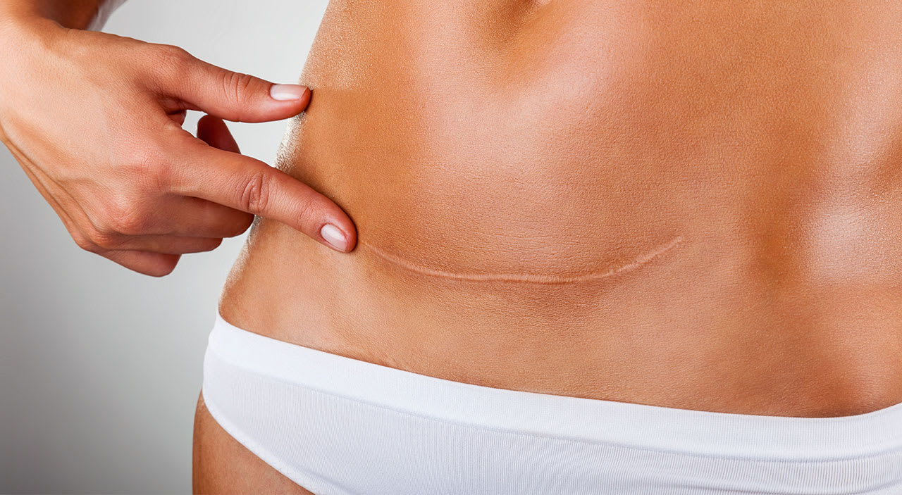 112 Tummy Tuck Scar Tattoo Ideas That Deserve More Love and Appreciation